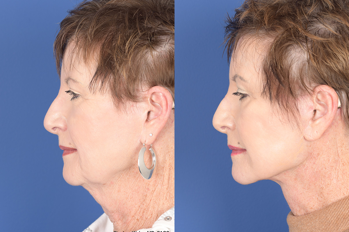 Facelift Before and After | Weber Facial Plastic Surgery