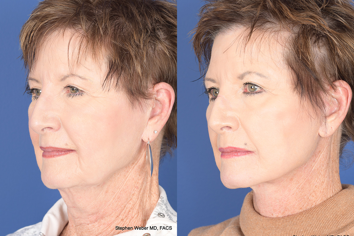 Facelift Before and After | Weber Facial Plastic Surgery