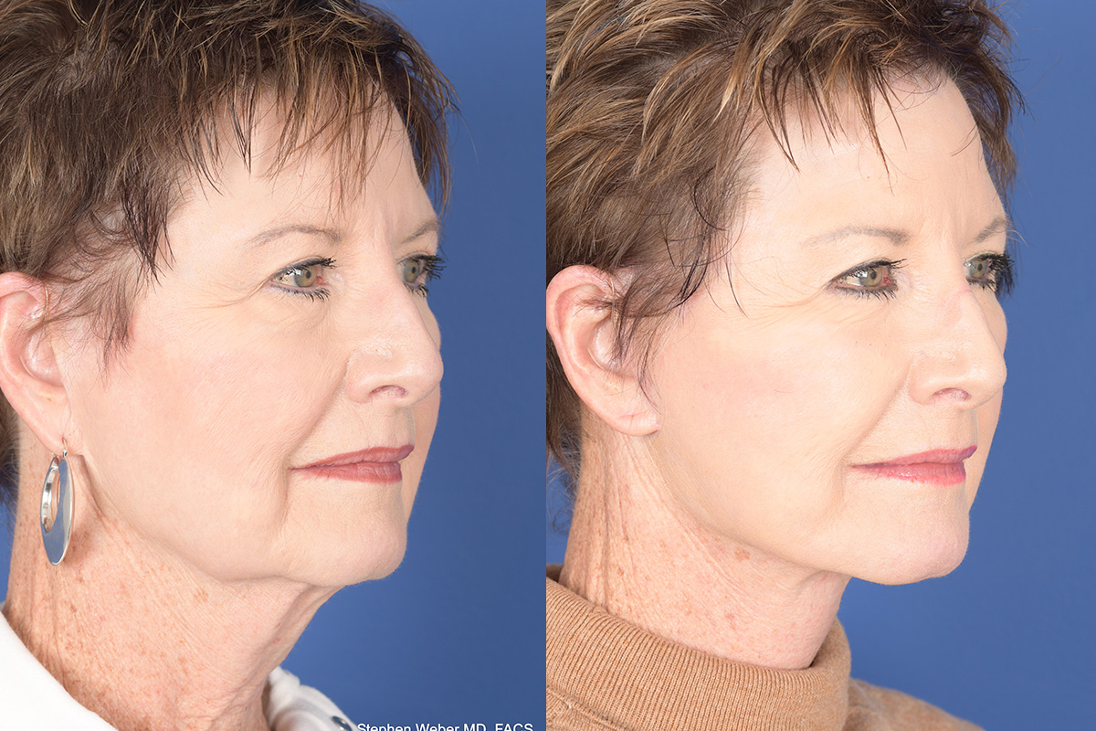 Facelift Before and After | Weber Facial Plastic Surgery
