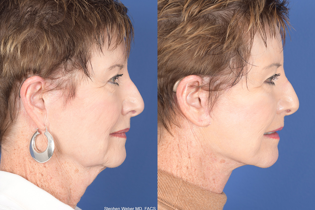 Facelift Before and After | Weber Facial Plastic Surgery