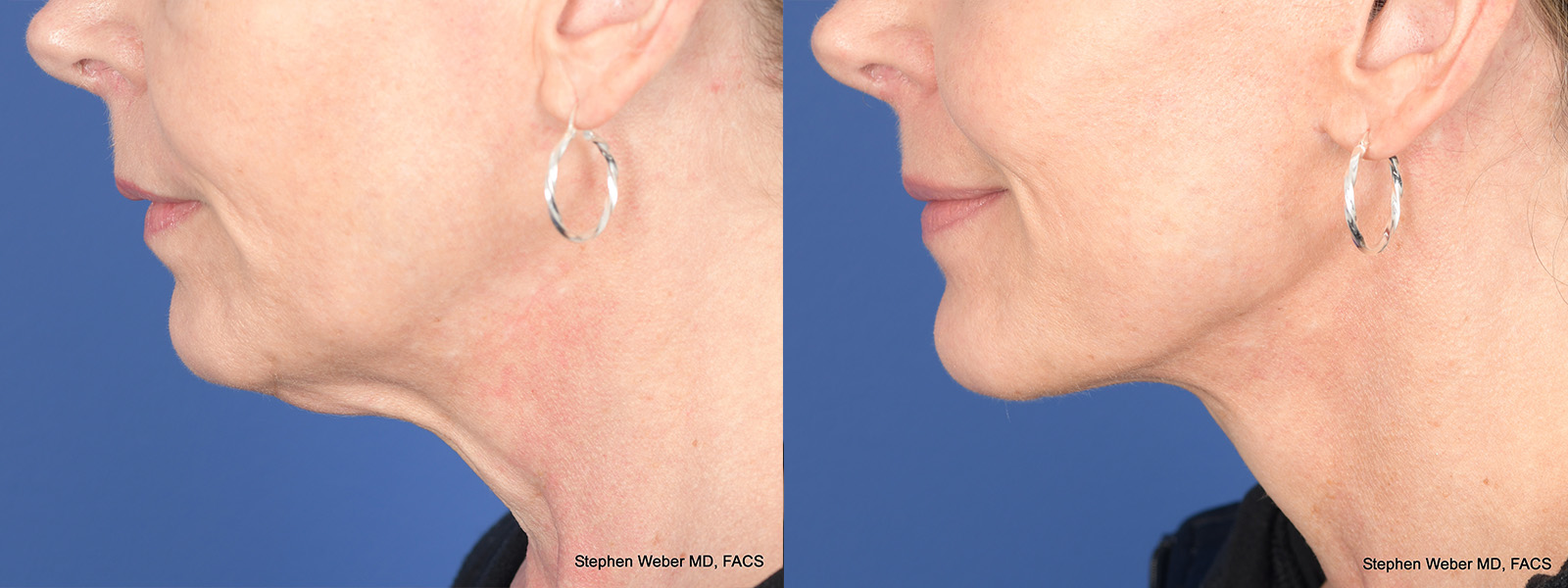 Facelift Before and After | Weber Facial Plastic Surgery
