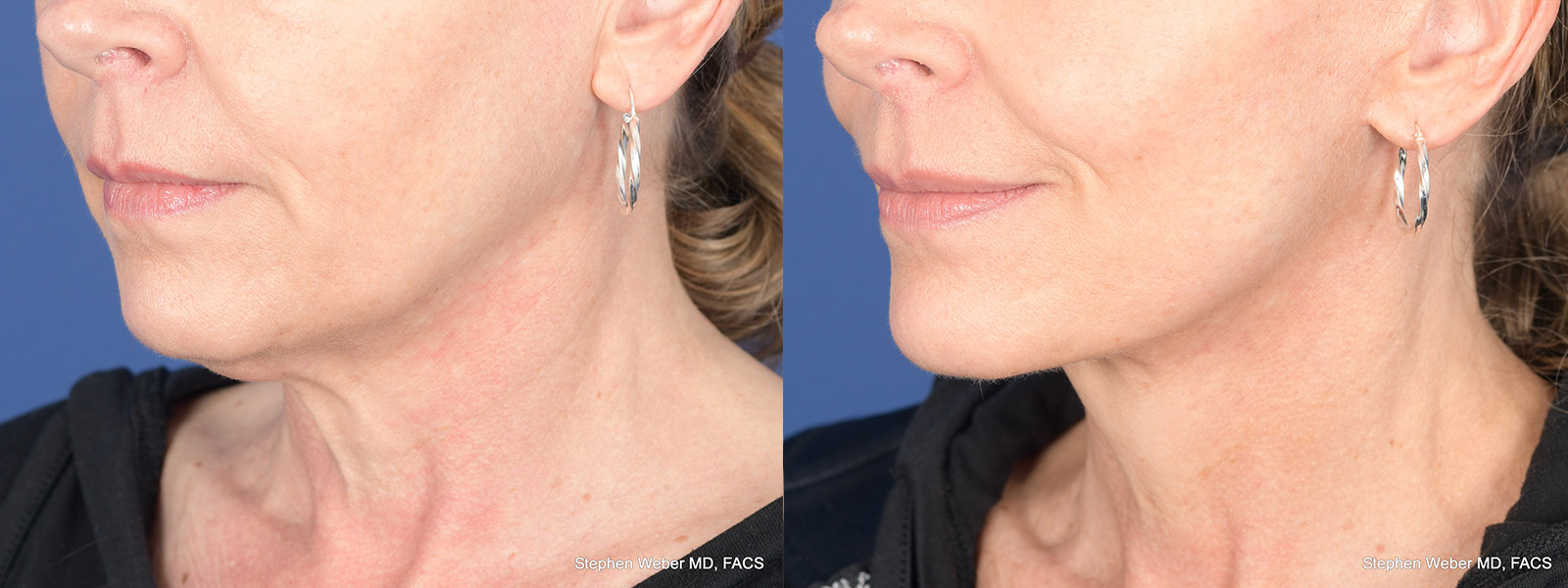 Facelift Before and After | Weber Facial Plastic Surgery
