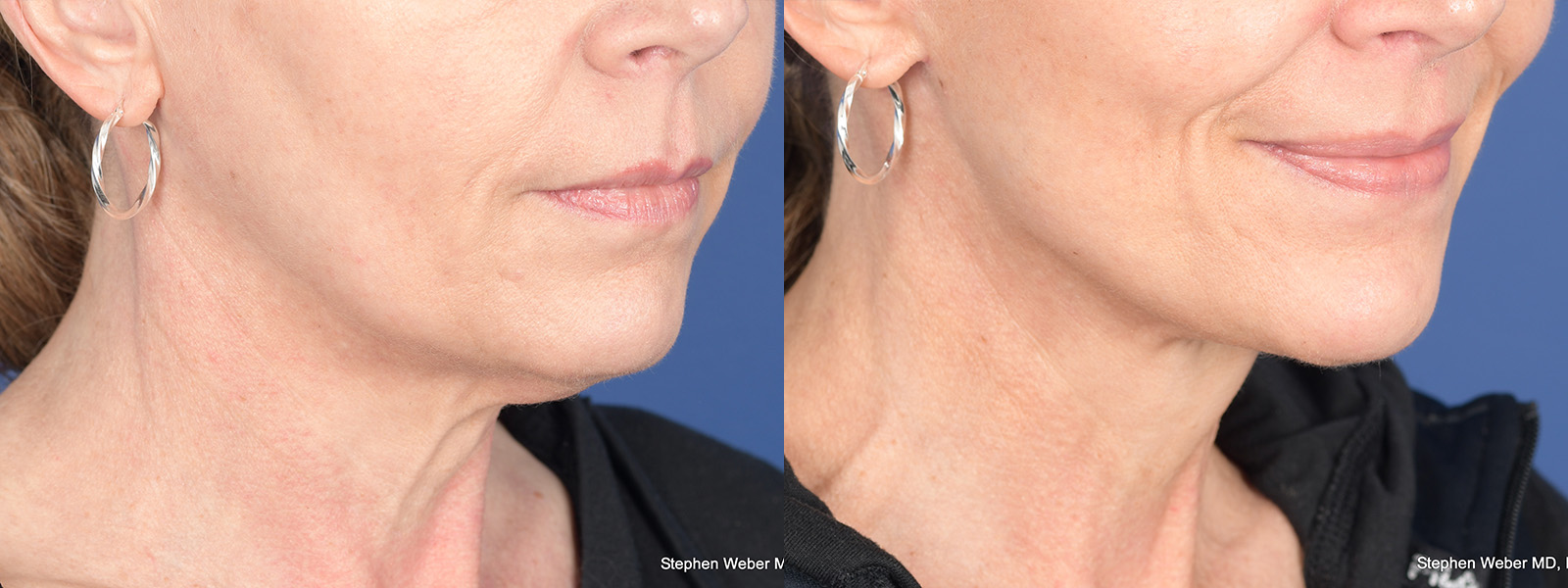 Facelift Before and After | Weber Facial Plastic Surgery