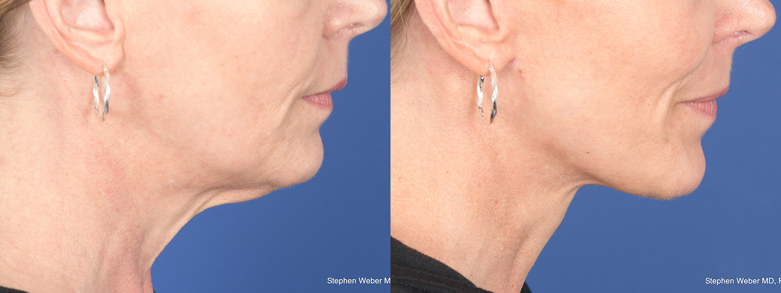 Facelift Before and After | Weber Facial Plastic Surgery