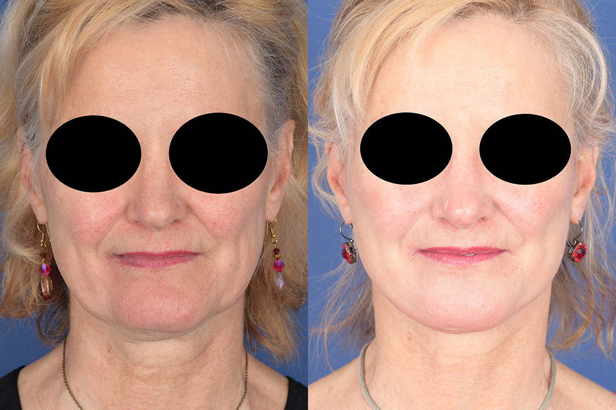 Facelift Before and After | Weber Facial Plastic Surgery
