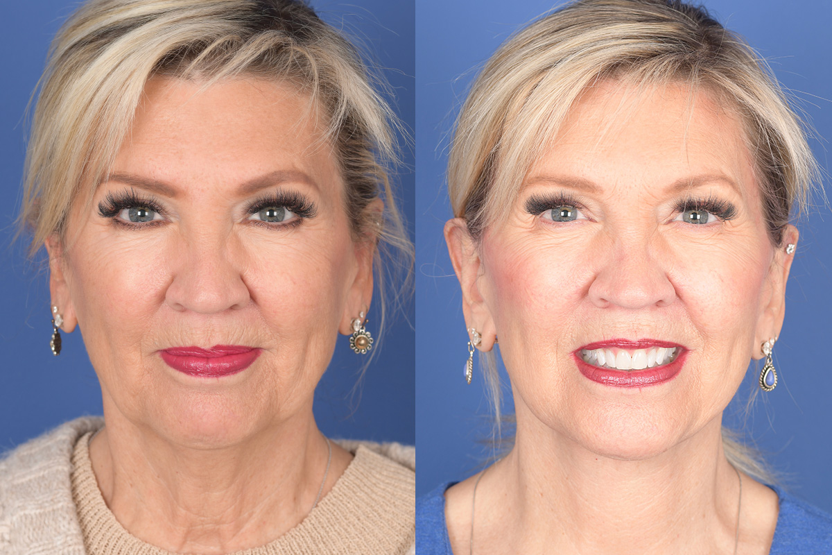 Facelift Before and After | Weber Facial Plastic Surgery