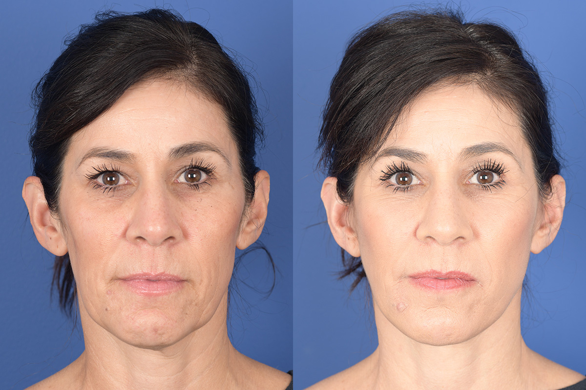 Facelift Before and After | Weber Facial Plastic Surgery