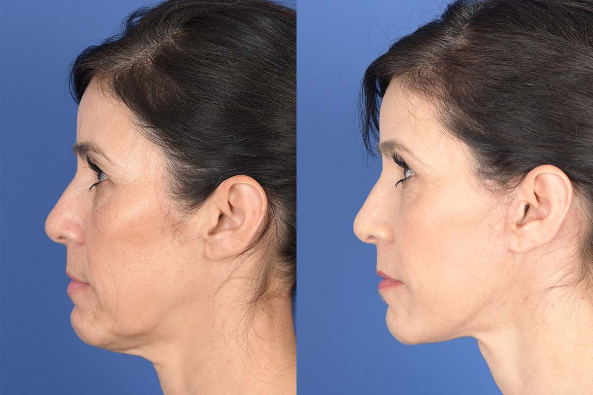 Facelift Before and After | Weber Facial Plastic Surgery