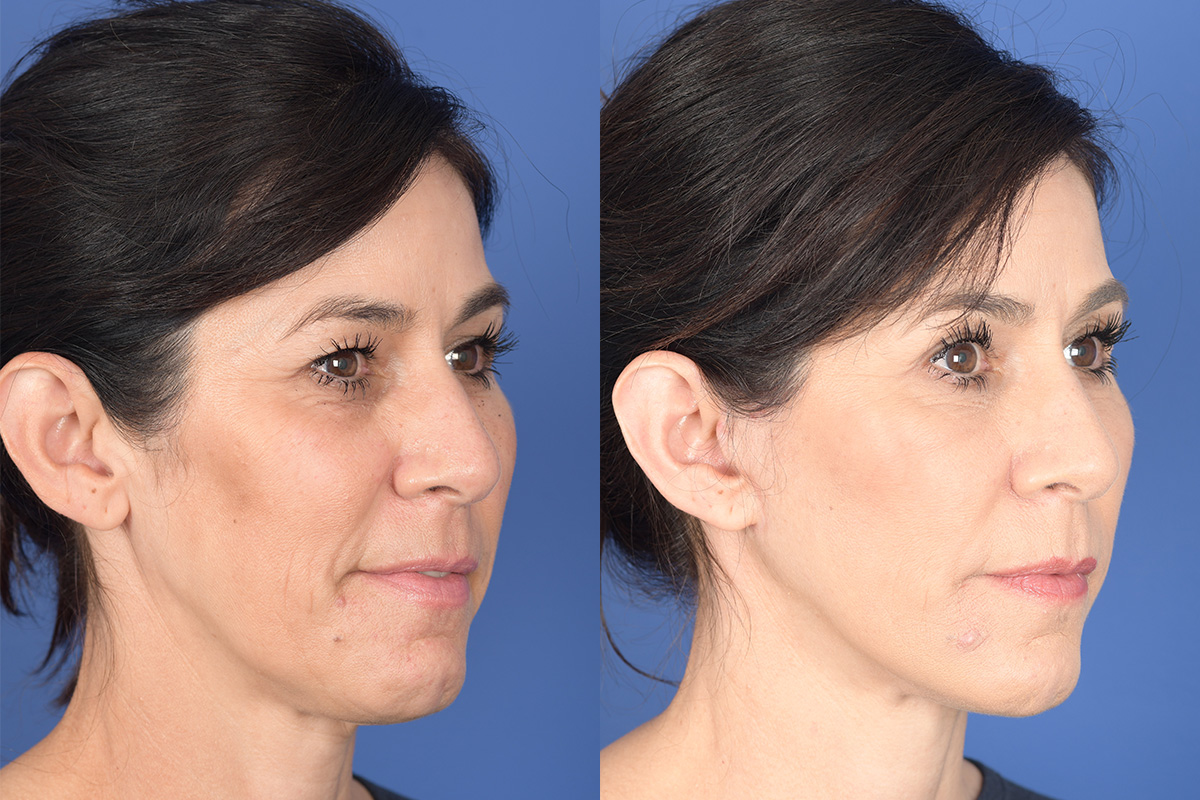 Facelift Before and After | Weber Facial Plastic Surgery
