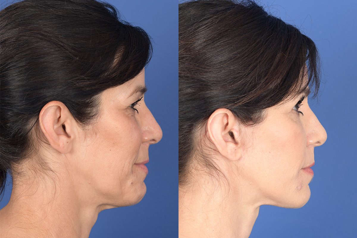 Facelift Before and After | Weber Facial Plastic Surgery