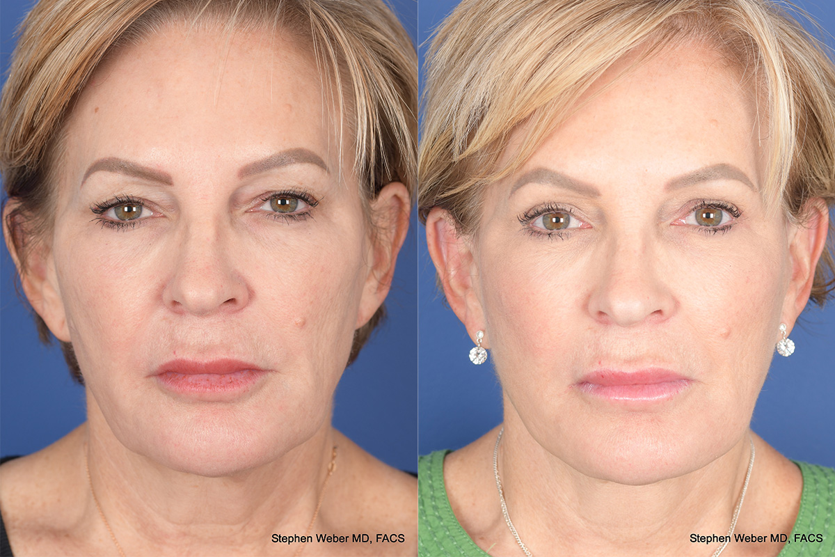 Facelift Before and After | Weber Facial Plastic Surgery