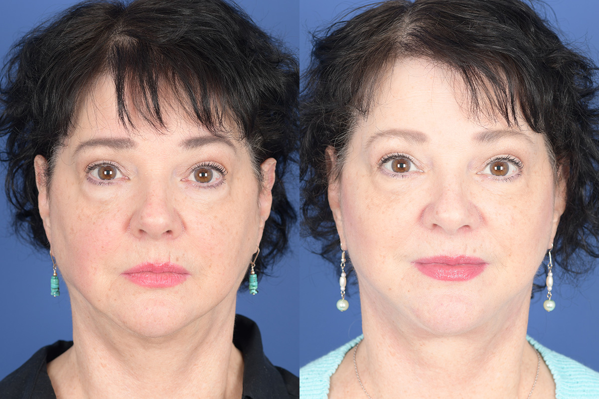 Facelift Before and After | Weber Facial Plastic Surgery