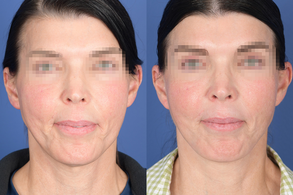 Facelift Before and After | Weber Facial Plastic Surgery