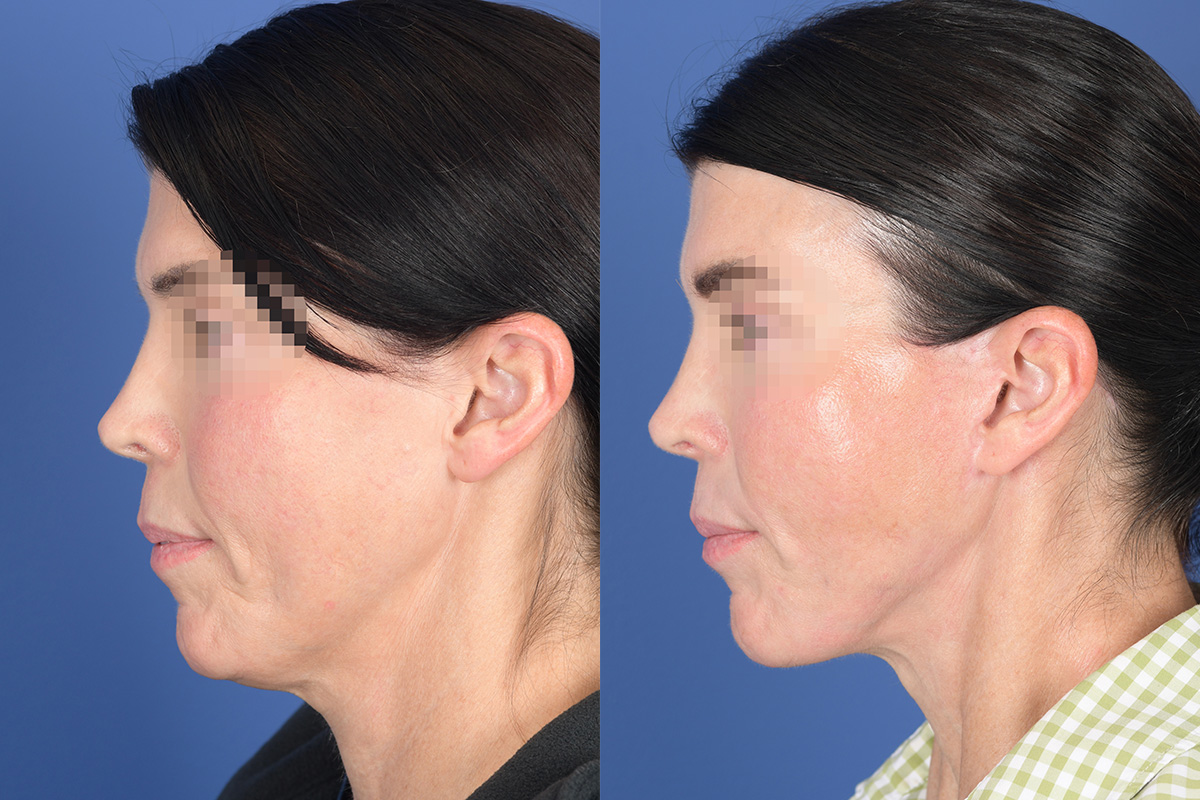 Facelift Before and After | Weber Facial Plastic Surgery