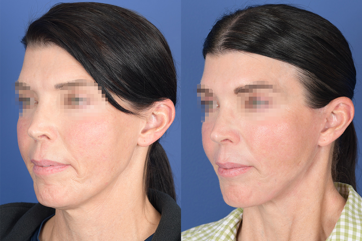 Facelift Before and After | Weber Facial Plastic Surgery
