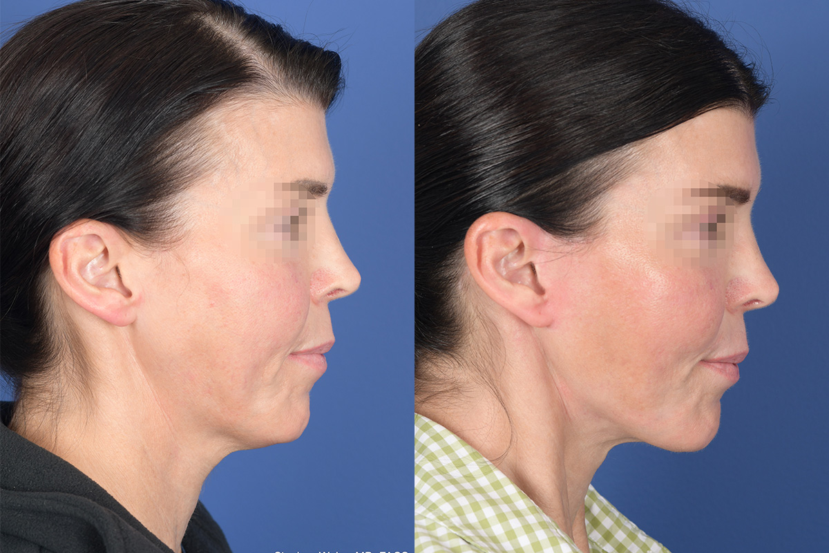 Facelift Before and After | Weber Facial Plastic Surgery