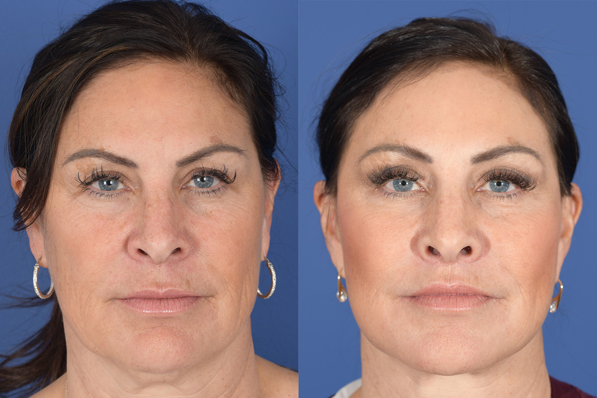 Facelift Before and After | Weber Facial Plastic Surgery