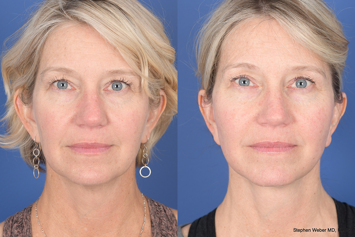 Facelift Before and After | Weber Facial Plastic Surgery