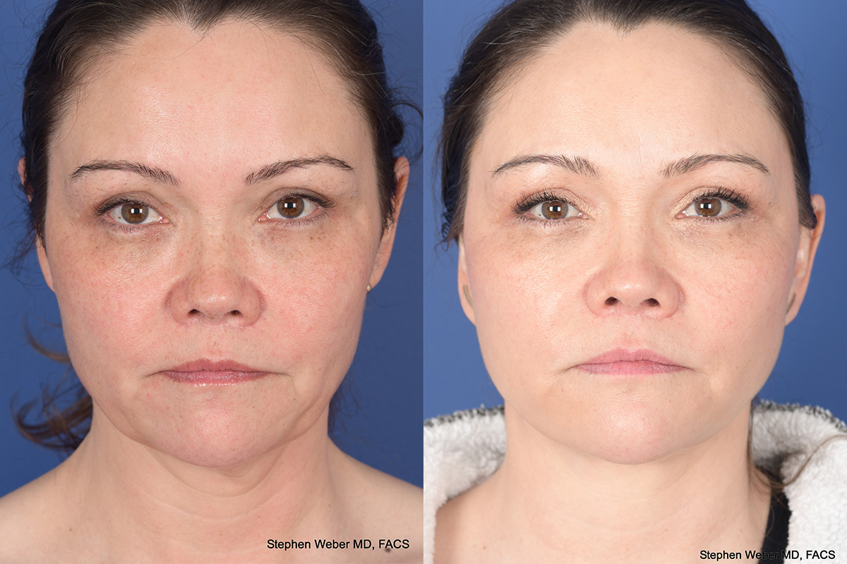Facelift Before and After | Weber Facial Plastic Surgery
