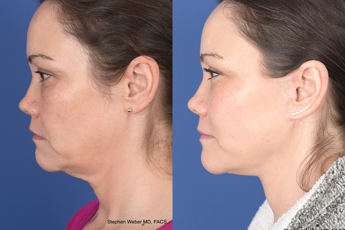 Facelift Before and After | Weber Facial Plastic Surgery