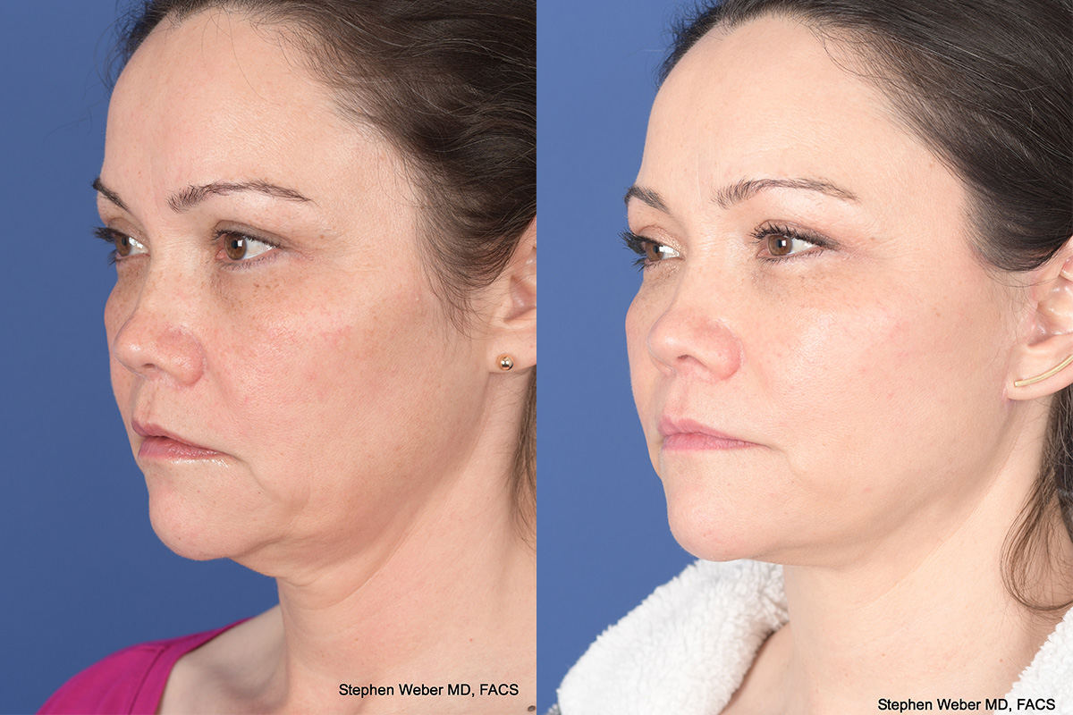 Facelift Before and After | Weber Facial Plastic Surgery