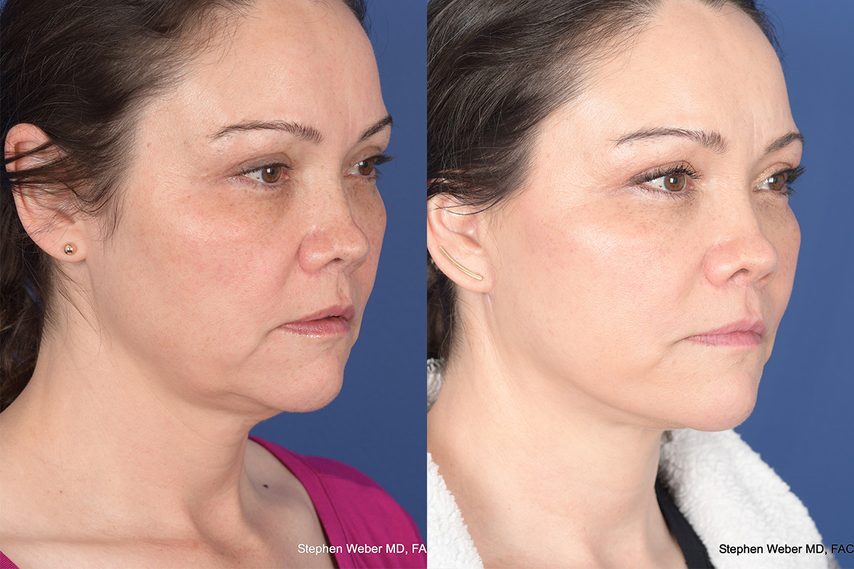 Facelift Before and After | Weber Facial Plastic Surgery
