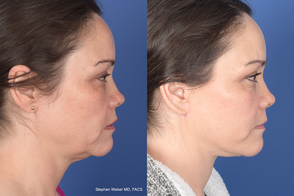 Facelift Before and After | Weber Facial Plastic Surgery