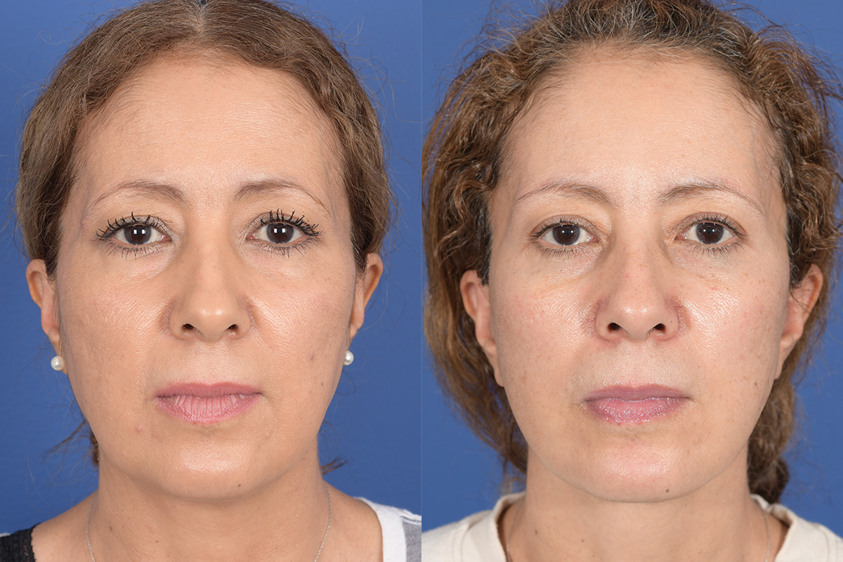 Facelift Before and After | Weber Facial Plastic Surgery