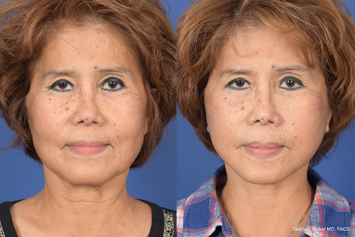Facelift Before and After | Weber Facial Plastic Surgery