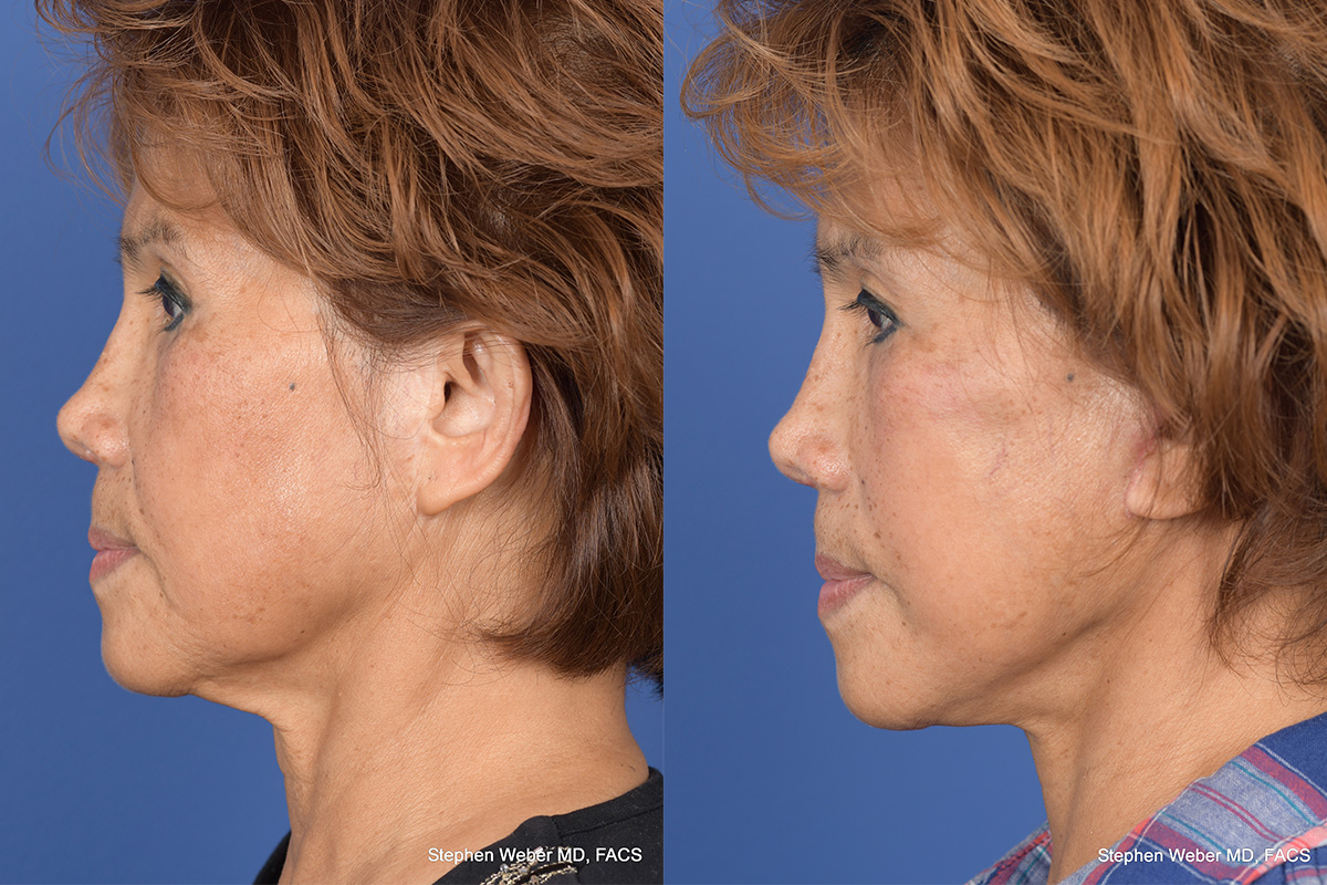 Facelift Before and After | Weber Facial Plastic Surgery