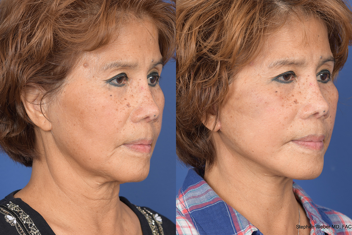 Facelift Before and After | Weber Facial Plastic Surgery