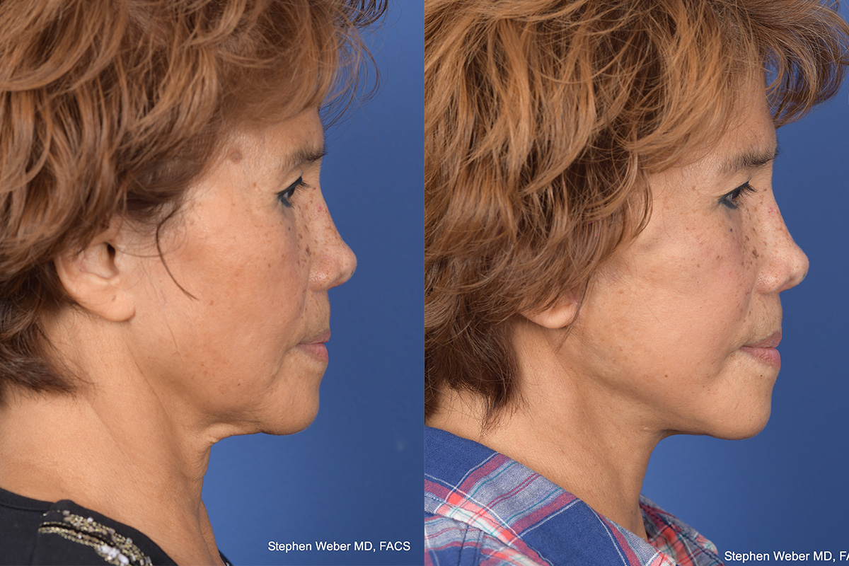 Facelift Before and After | Weber Facial Plastic Surgery