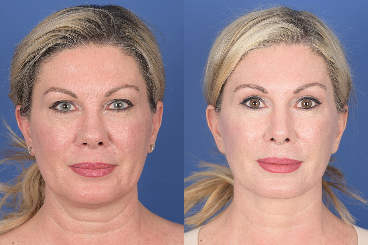 Facelift Before and After | Weber Facial Plastic Surgery
