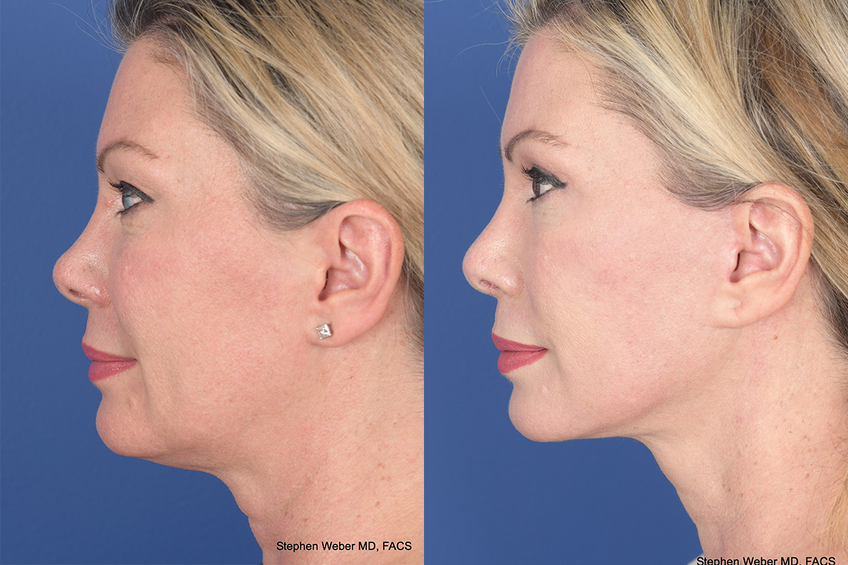Facelift Before and After | Weber Facial Plastic Surgery