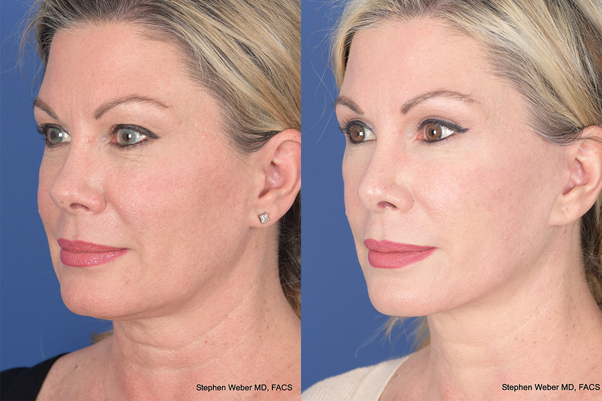 Facelift Before and After | Weber Facial Plastic Surgery