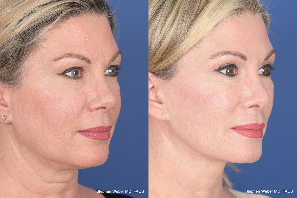 Facelift Before and After | Weber Facial Plastic Surgery