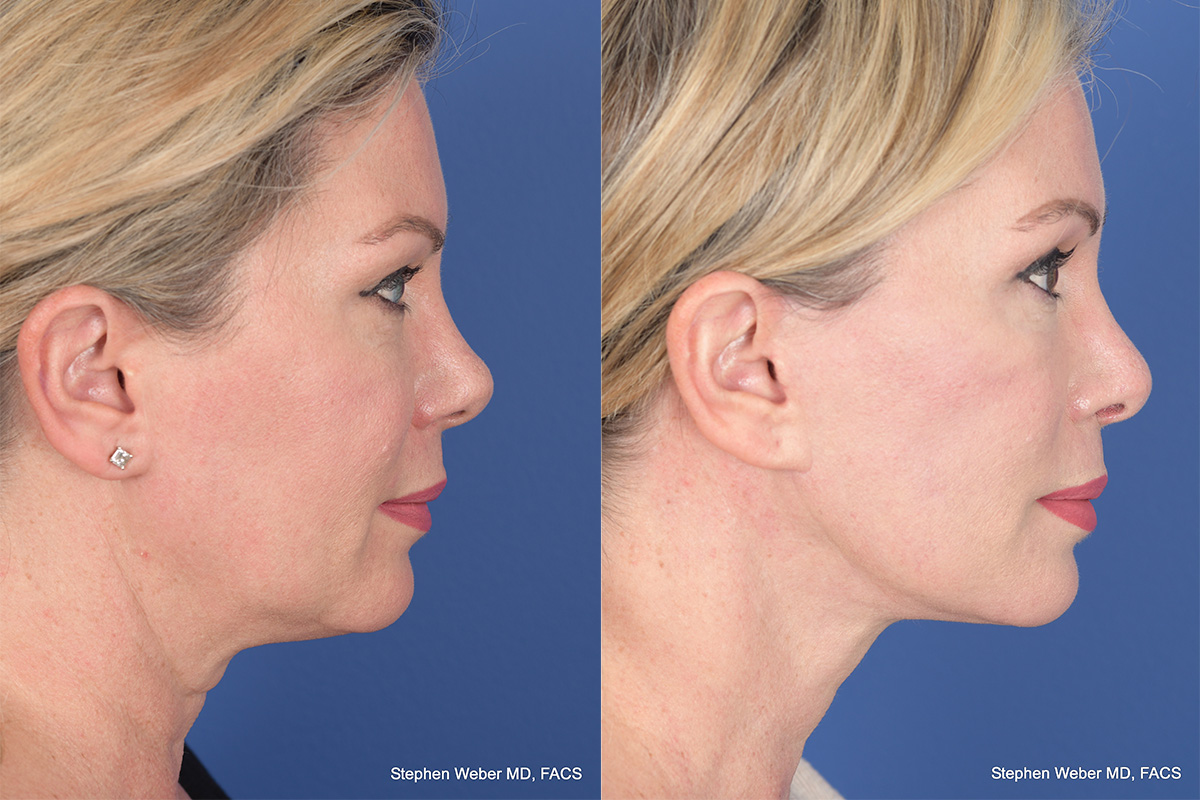 Facelift Before and After | Weber Facial Plastic Surgery