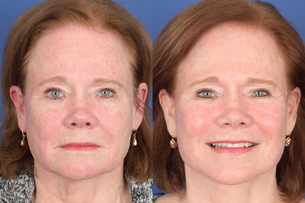 Facelift Before and After | Weber Facial Plastic Surgery