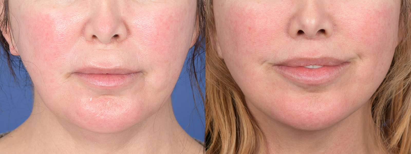 Facelift Before and After | Weber Facial Plastic Surgery