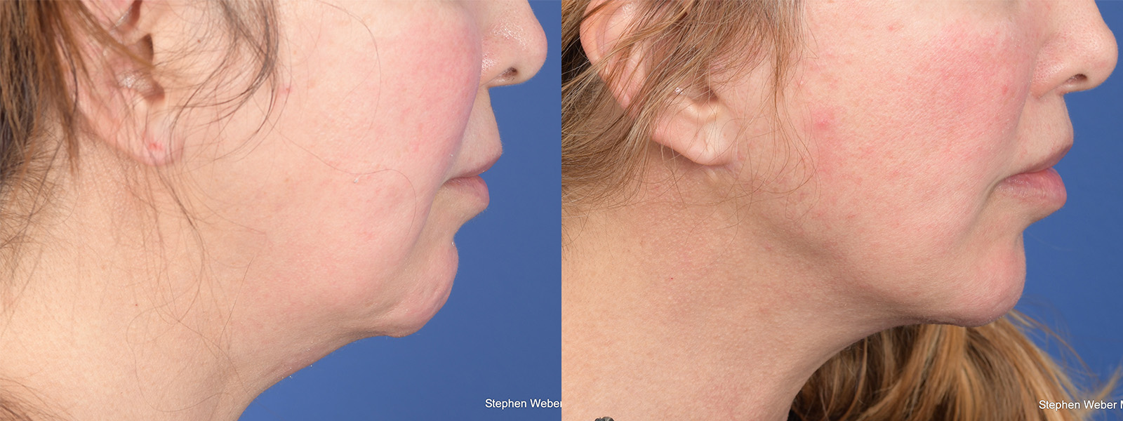 Facelift Before and After | Weber Facial Plastic Surgery