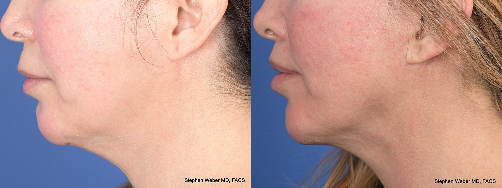 Facelift Before and After | Weber Facial Plastic Surgery