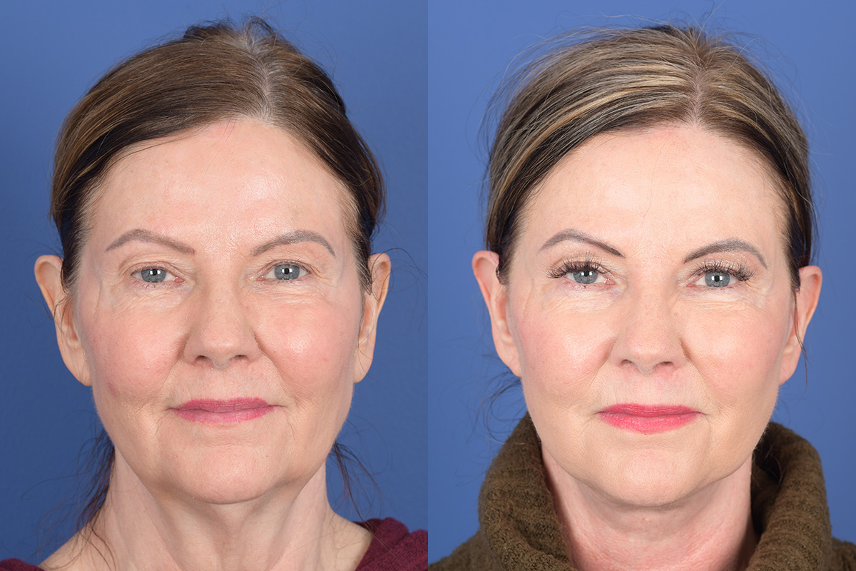 Facelift Before and After | Weber Facial Plastic Surgery