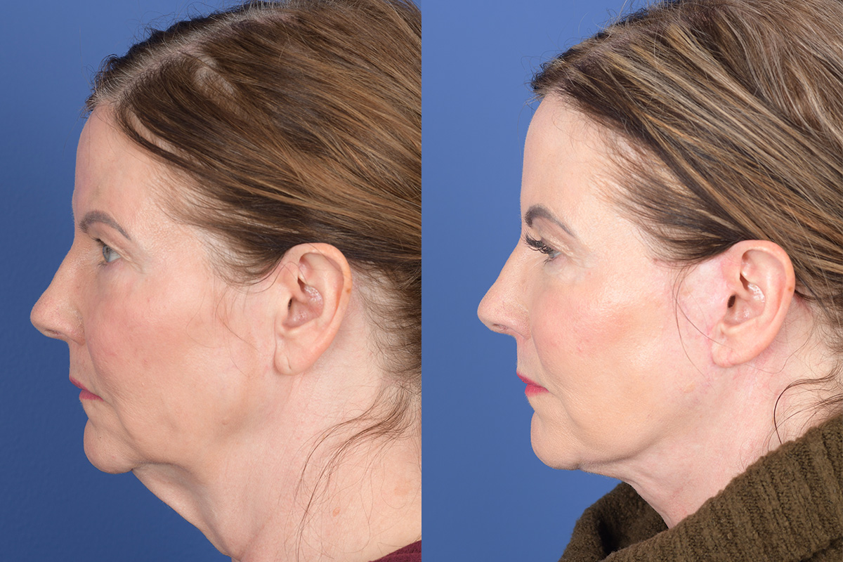 Facelift Before and After | Weber Facial Plastic Surgery