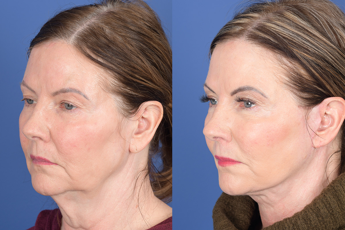 Facelift Before and After | Weber Facial Plastic Surgery