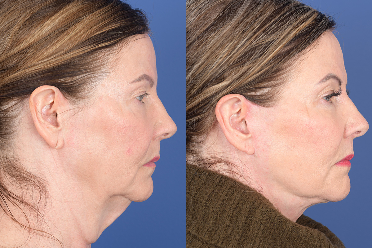 Facelift Before and After | Weber Facial Plastic Surgery