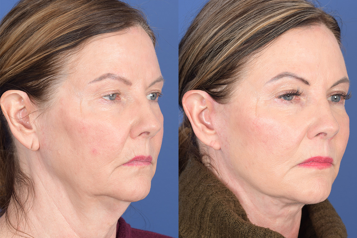 Facelift Before and After | Weber Facial Plastic Surgery