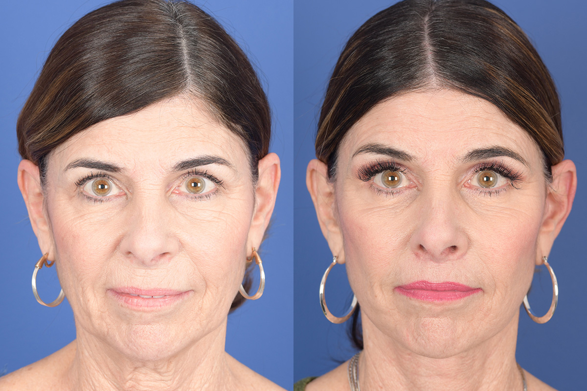 Facelift Before and After | Weber Facial Plastic Surgery