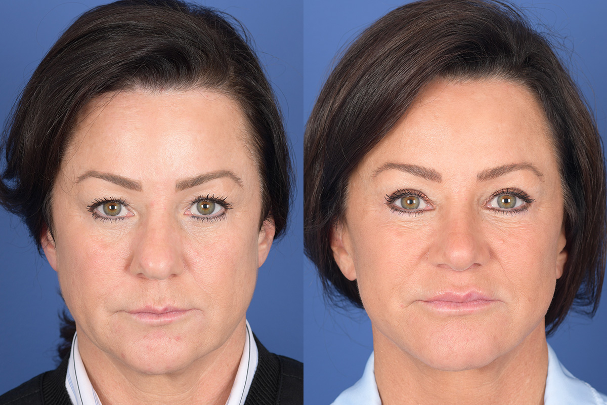 Facelift Before and After | Weber Facial Plastic Surgery