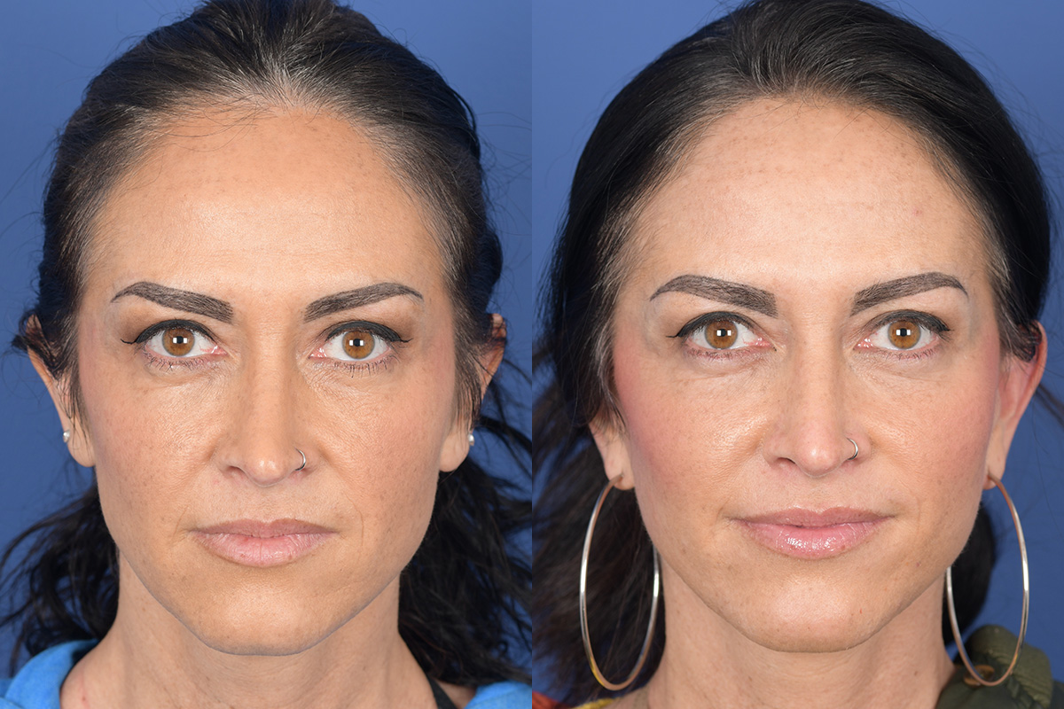 Facelift Before and After | Weber Facial Plastic Surgery