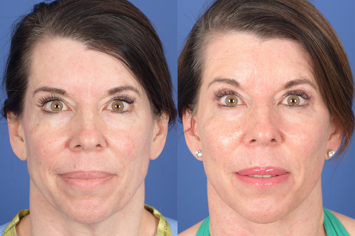 Facelift Before and After | Weber Facial Plastic Surgery